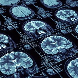Brain CT scans result